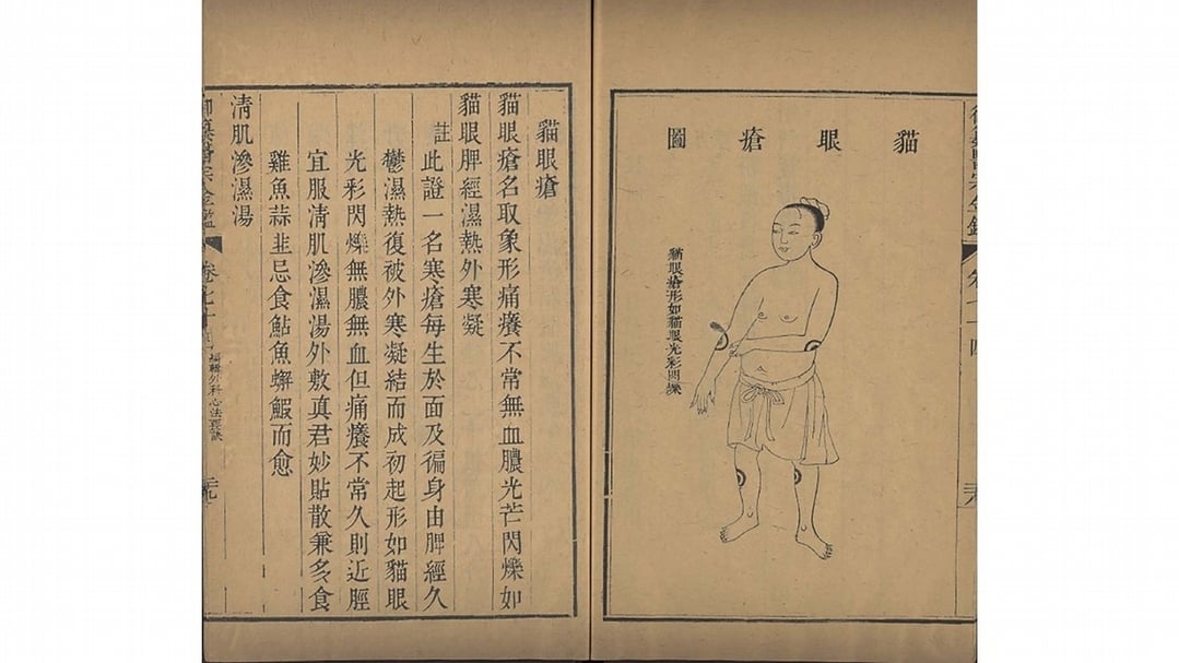 清吳謙、劉裕鐸《御纂醫宗金鑑》之「貓眼瘡」，乾隆七年（1742）武英殿刊本，國立故宮博物院藏。（國立故宮博物院提供）