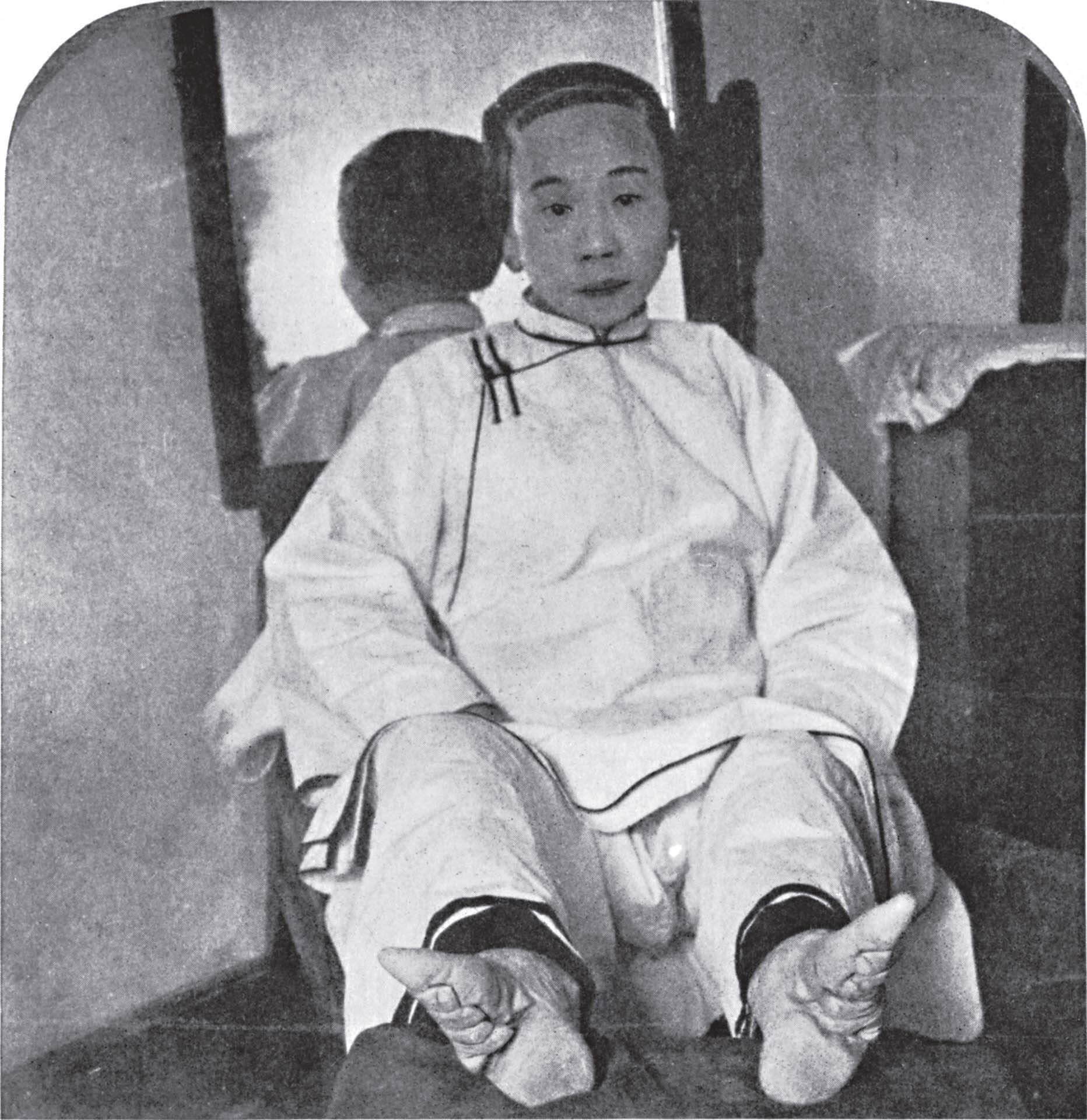 圖11 纏足導致的畸形足，展場中以圖版形式呈現。©Public Domain