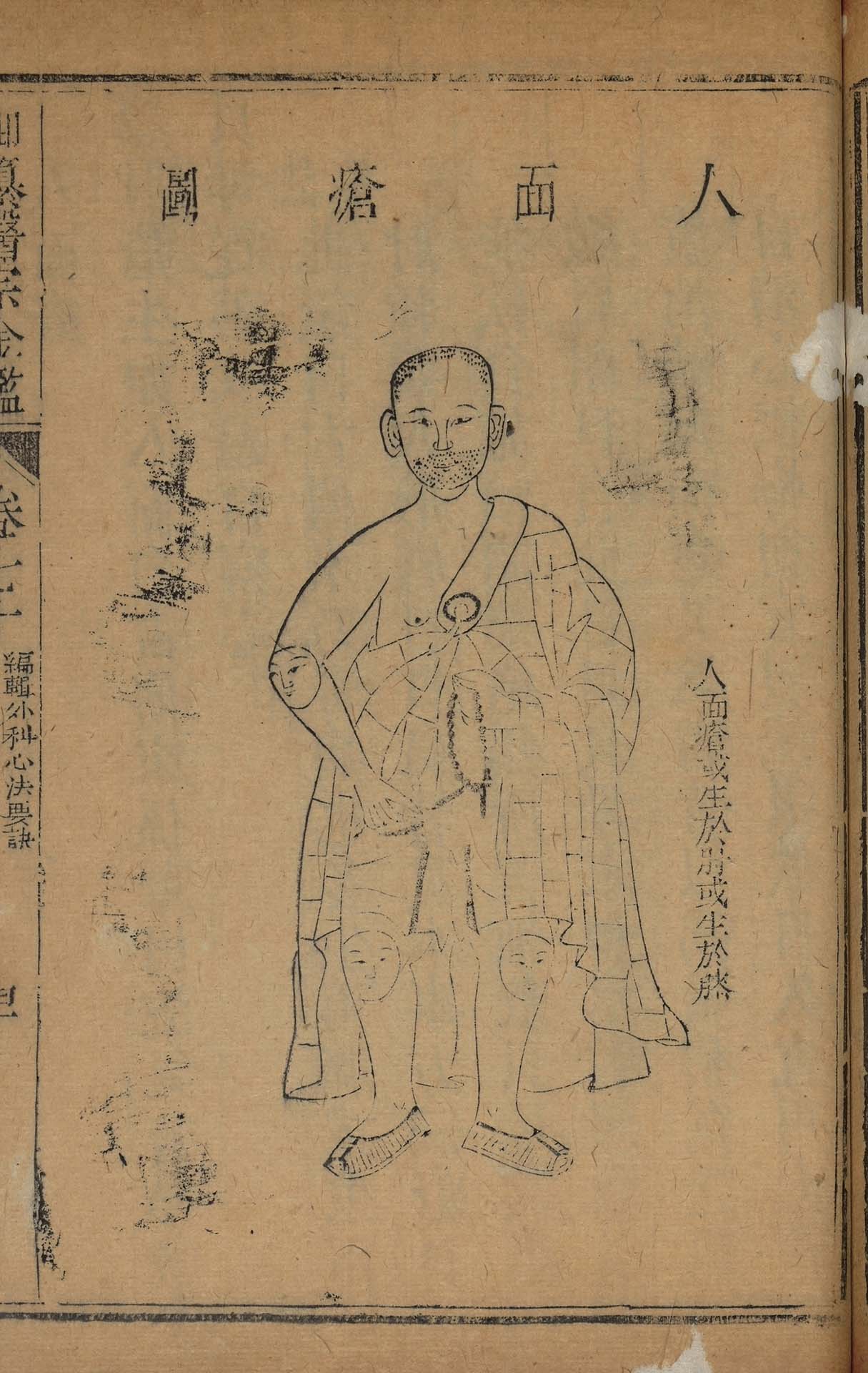圖7 清 吳謙等《御纂醫宗金鑑．人面瘡圖》，清乾隆七年武英殿刊本，國立故宮博物院藏，現正展出中。圖／國立故宮博物院。