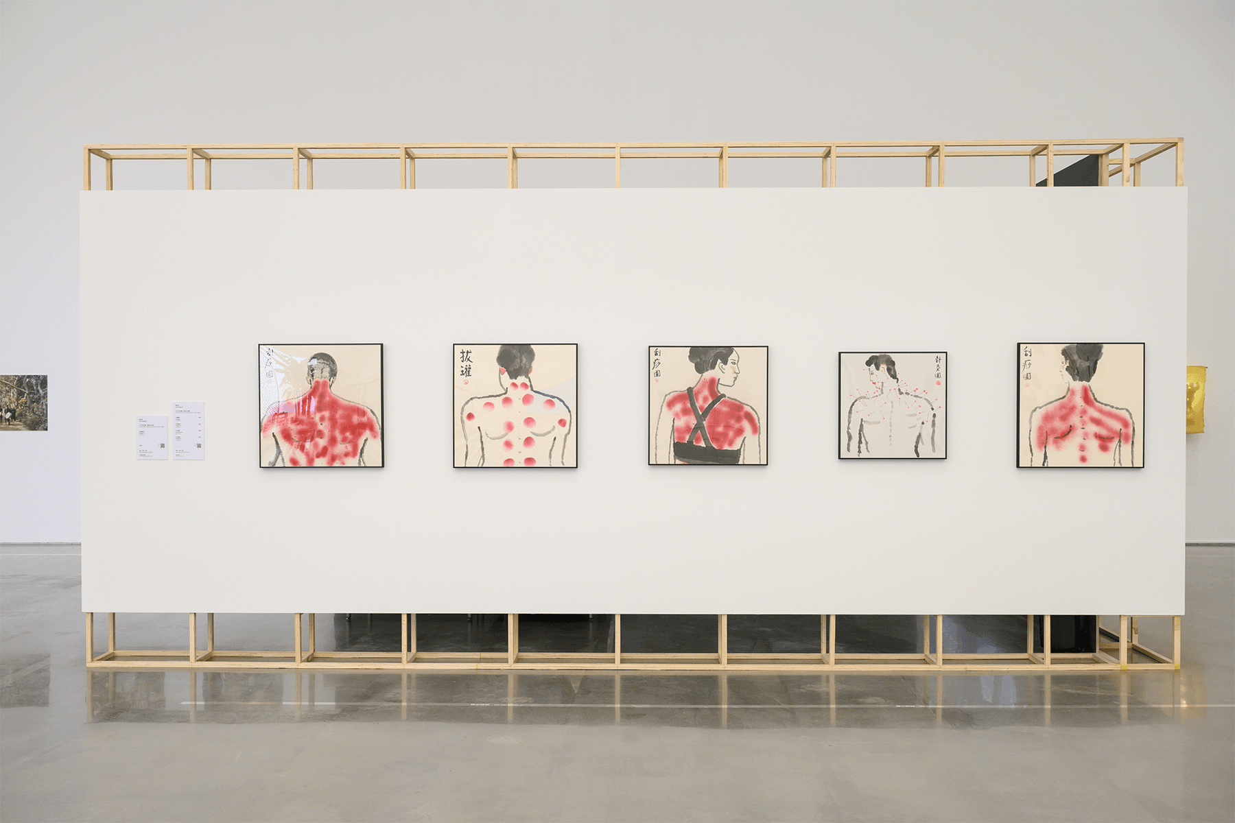 蔡宗祐作品《刮痧圖2》、《刮痧圖3》、《刮痧圖4》、《拔罐圖》、《針灸圖》於展覽現場。攝影：卓杜信XhinMania。（圖片來源：臺中市立美術館）